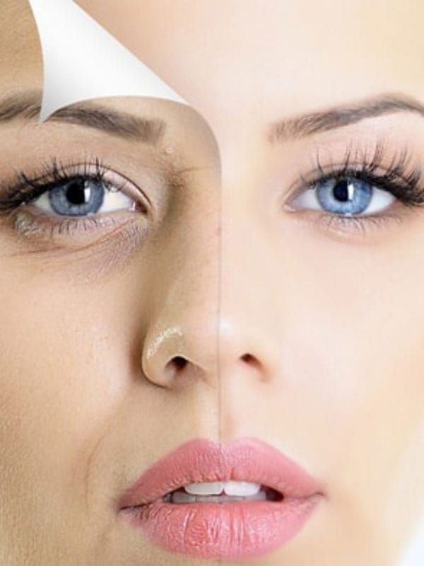 peeling-chimico-monza-brianza-come-vert