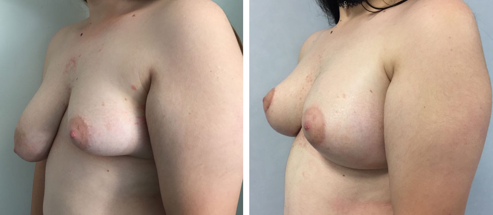ASIMMETRIA MAMMARIA 5 asimmetria-mammaria01-prepost