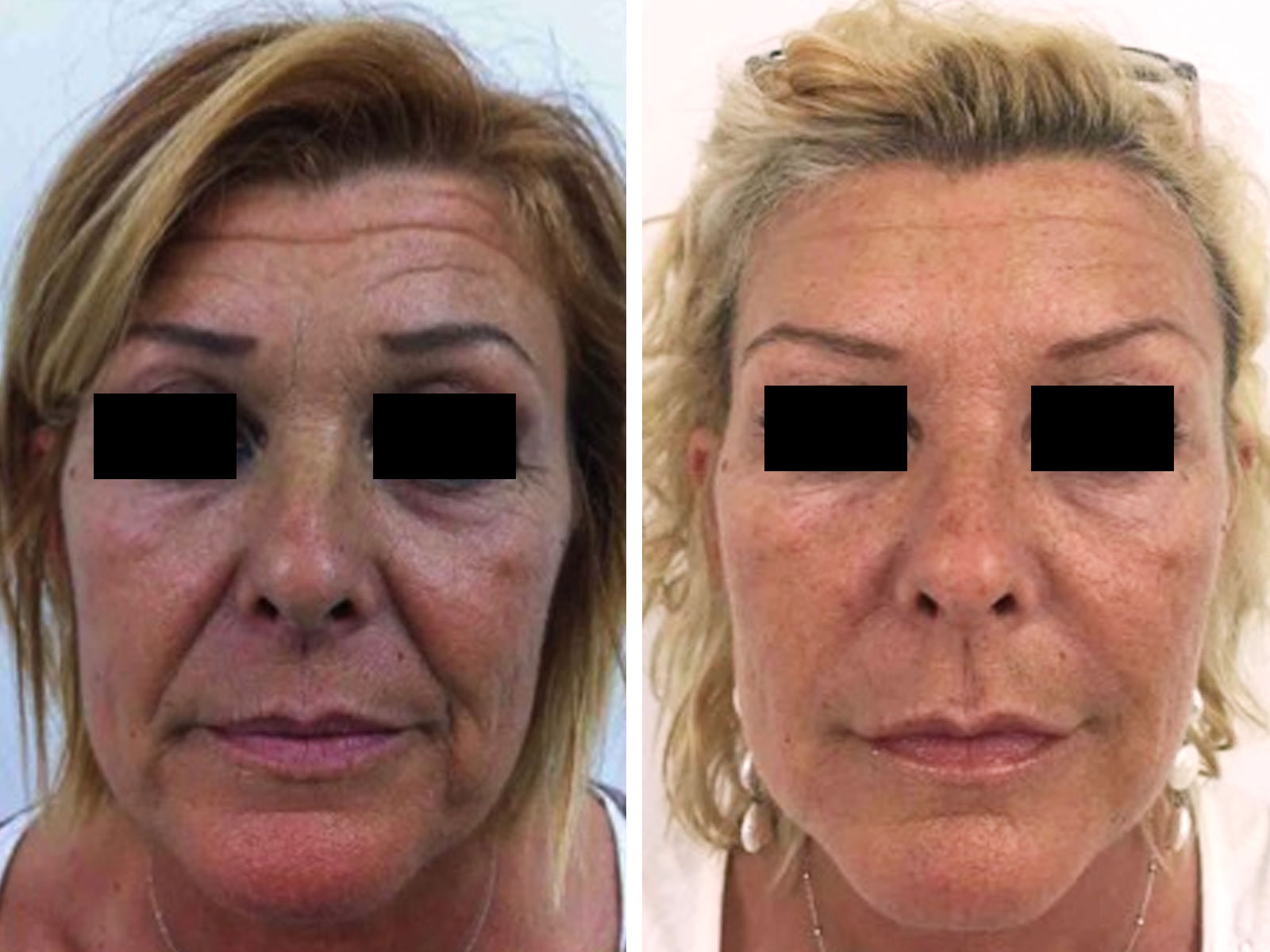 trattamenti filler viso