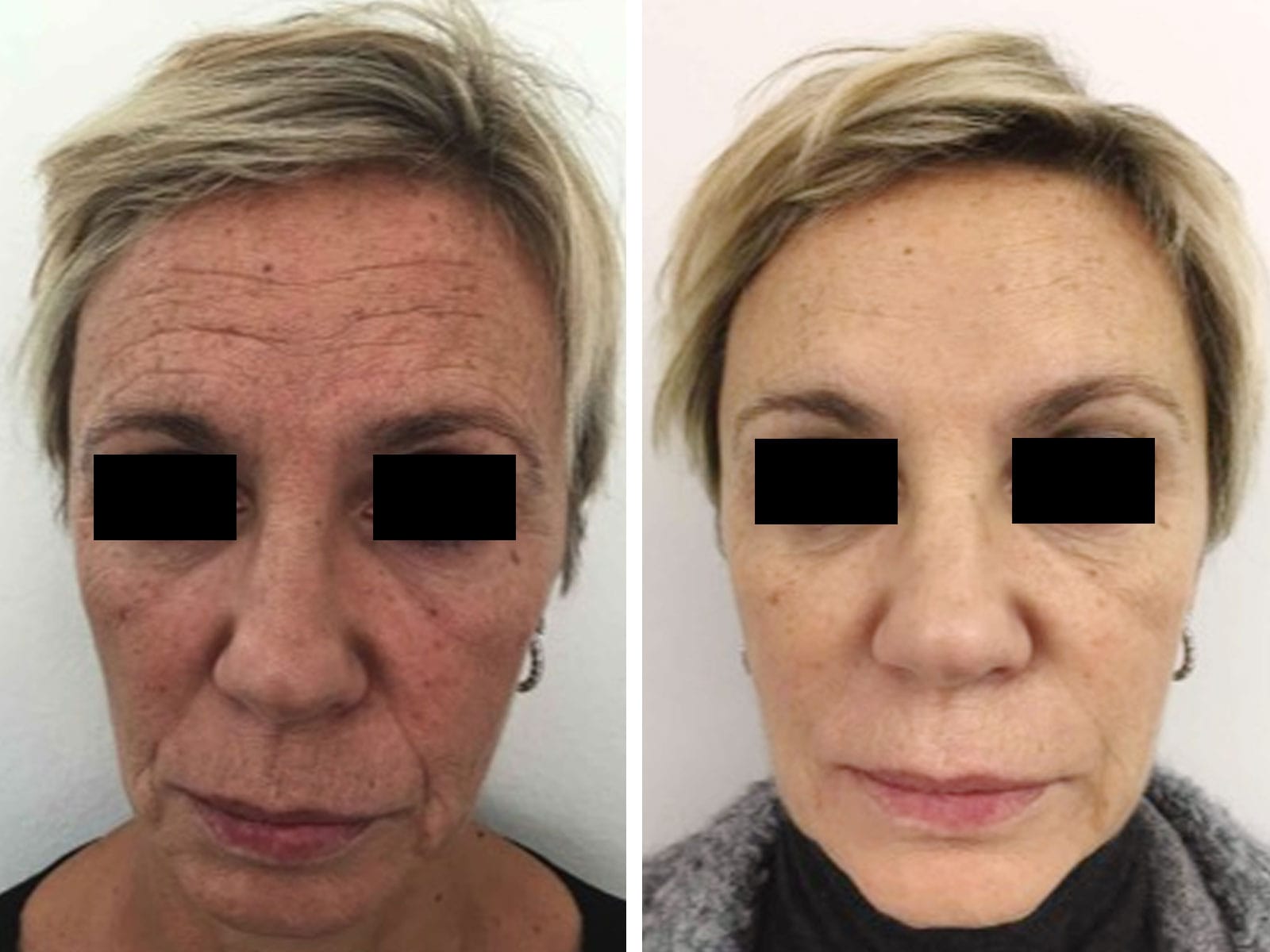 FILLER 3 fillers02-prepost