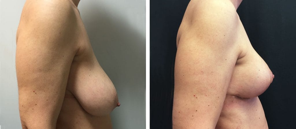 Foto Mastoplastica Riduttiva prima e dopo 35 mastoplastica-riduttiva02-prepost