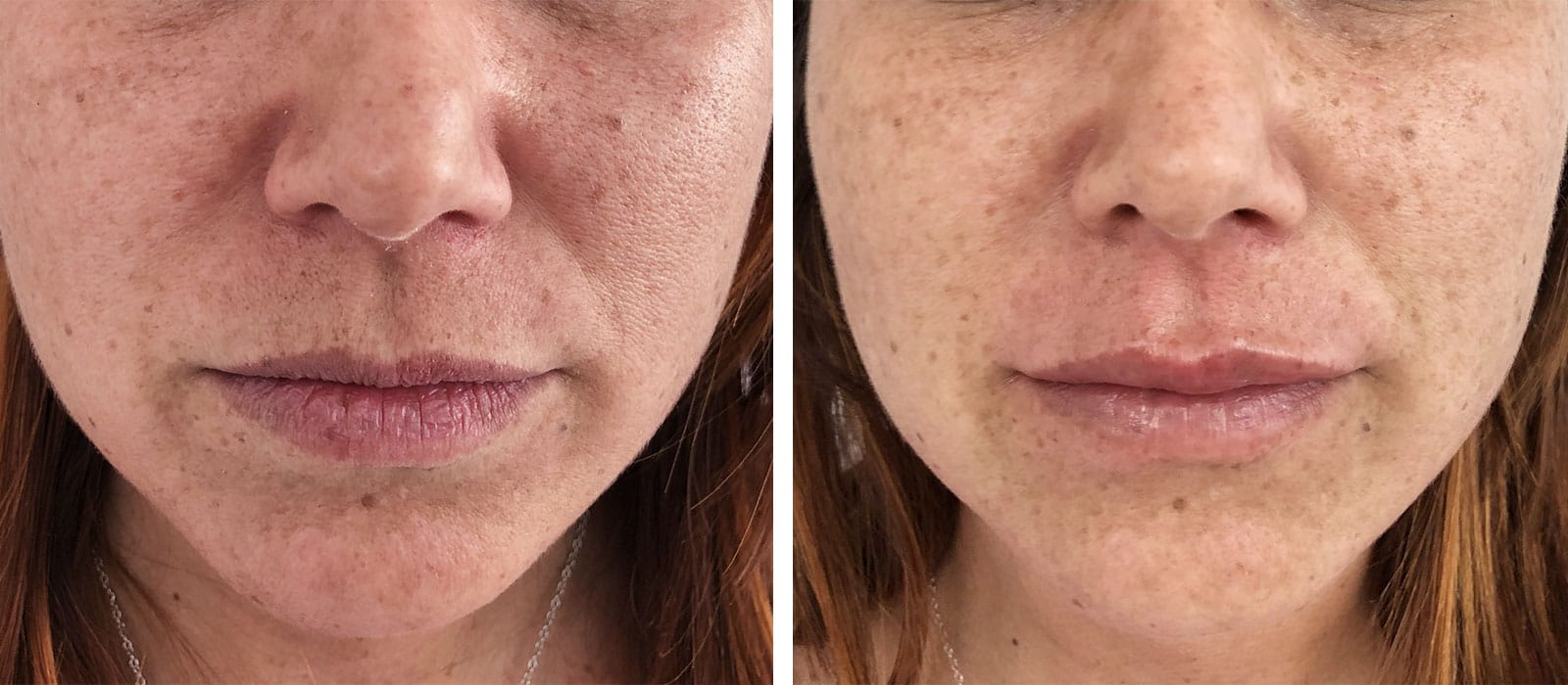 FILLER 5 filler labbra pre