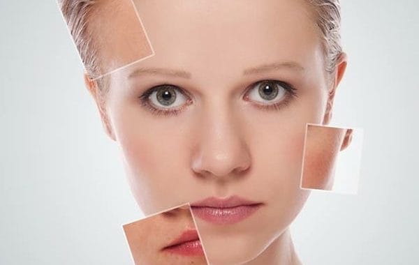 microneedling monza como