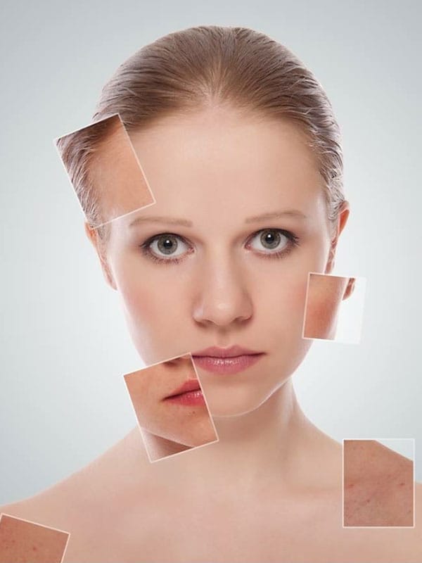 microneedling monza como