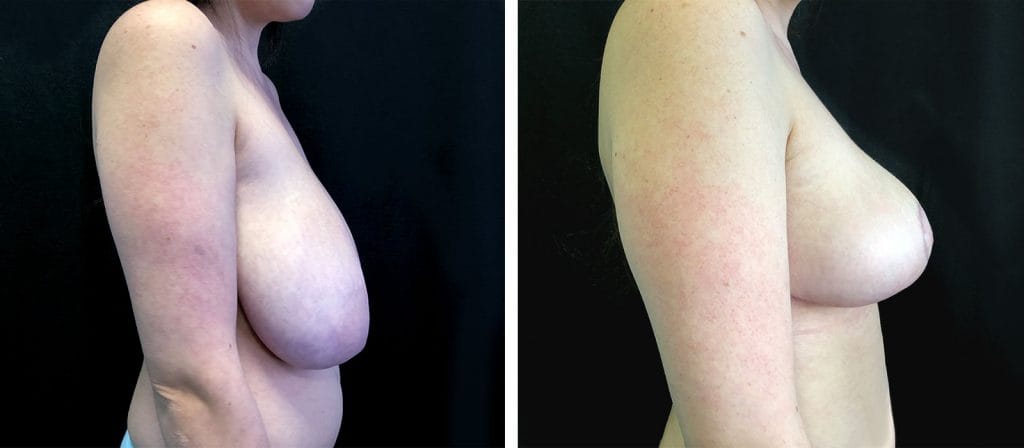 Foto Mastoplastica Riduttiva prima e dopo 34 mastoplastica-riduttiva03-prepost