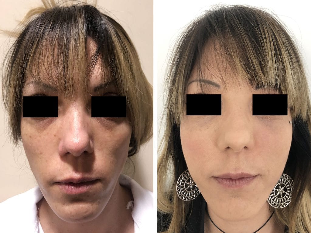 Chirurgo plastico Monza - Lipofilling