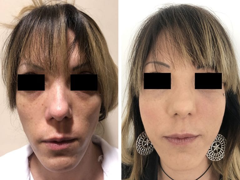 Chirurgo plastico Monza - Lipofilling