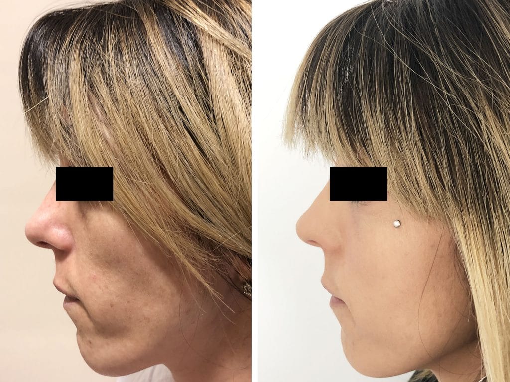 Chirurgo plastico Monza - Lipofilling