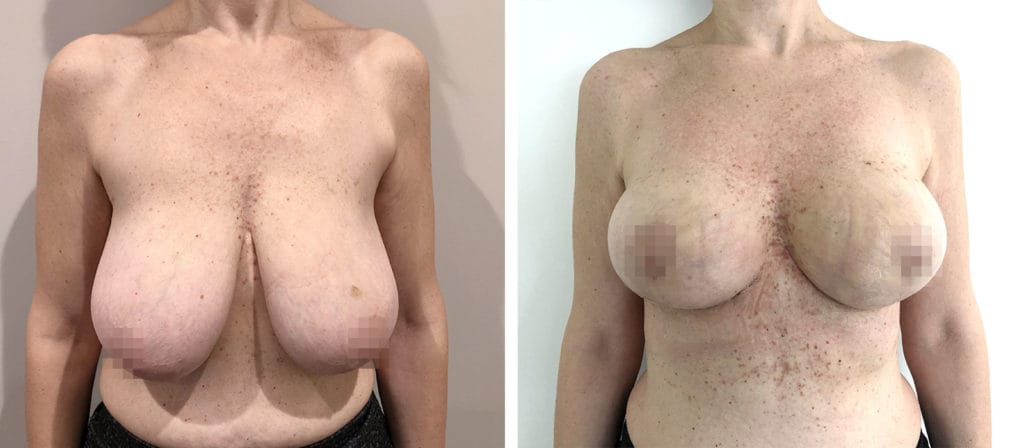 Foto Mastoplastica Riduttiva prima e dopo 30 Chirurgo plastico Monza - Mastoplastica riduttiva