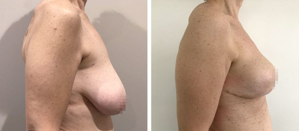 Foto Mastoplastica Riduttiva prima e dopo 28 Chirurgo plastico Monza - Mastoplastica riduttiva
