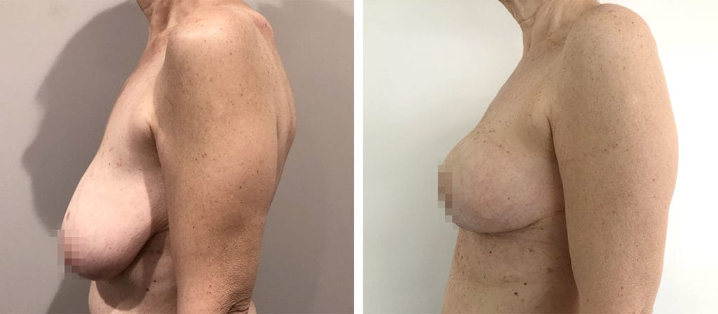 Foto Mastoplastica Riduttiva prima e dopo 27 Chirurgo plastico Monza - Mastoplastica riduttiva