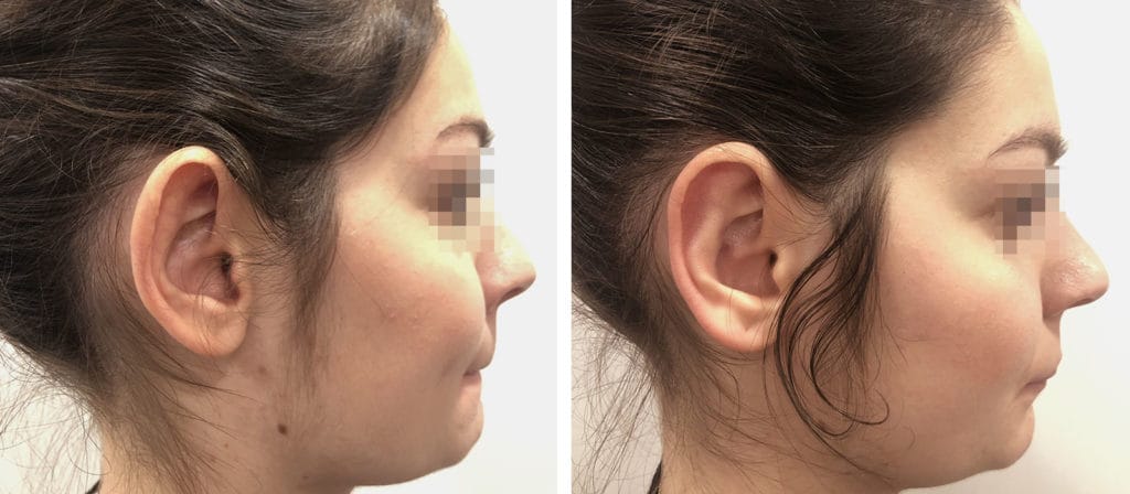 Chirurgo plastico Monza - Otoplastica