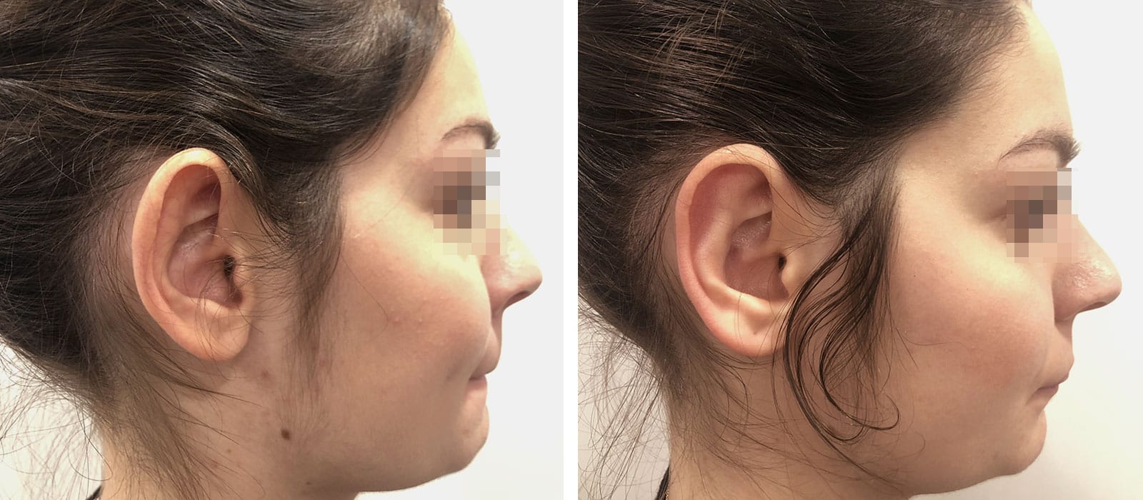 Chirurgo plastico Monza - Otoplastica
