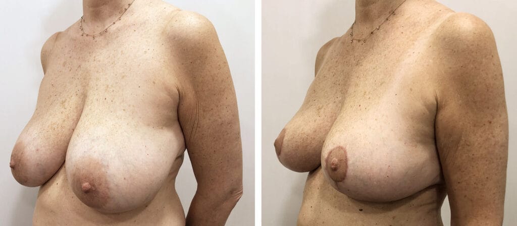Foto Mastoplastica Riduttiva prima e dopo 26 mastoplastica riduttiva06 01 prepost