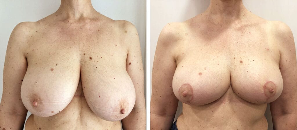 Foto Mastoplastica Riduttiva prima e dopo 25 mastoplastica riduttiva07 01 prepost