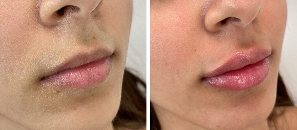 filler labbra como