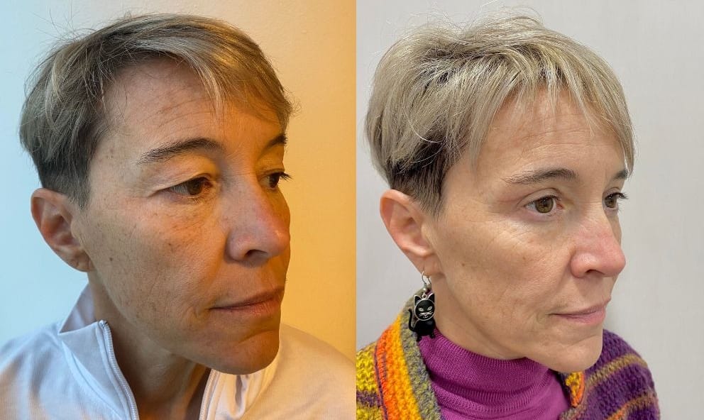blefaro superiore prima e dopo